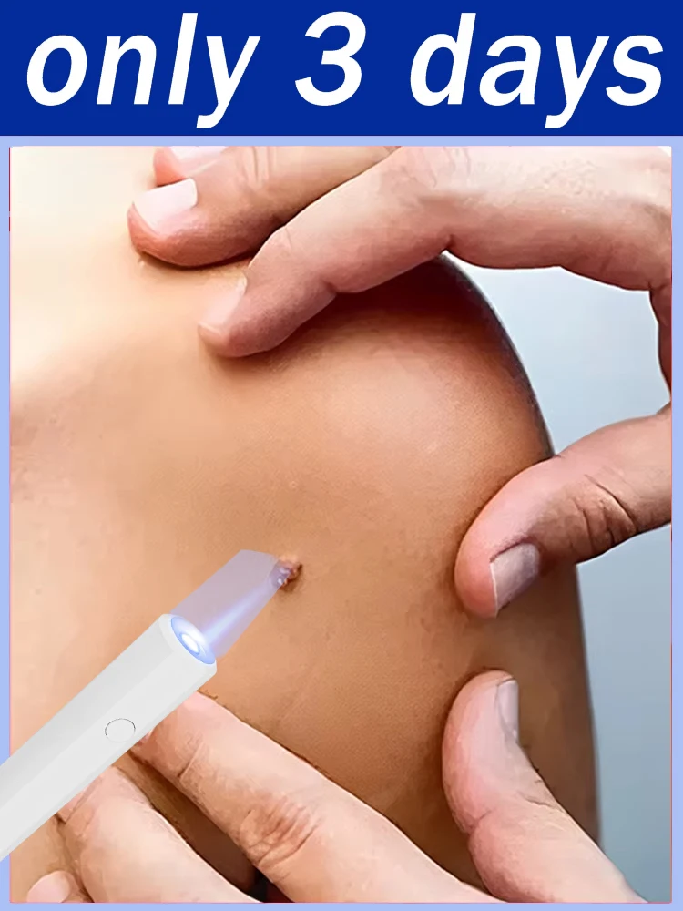 Multi-functinal Upgrade Blue Light Portable Lightweight Home Use Gentle Solve Warts Unisex Care Tool
Multi-functinal Upgrade Blue Light Portable Lightweight Home Use Gentle Solve Warts Unisex Care Tool