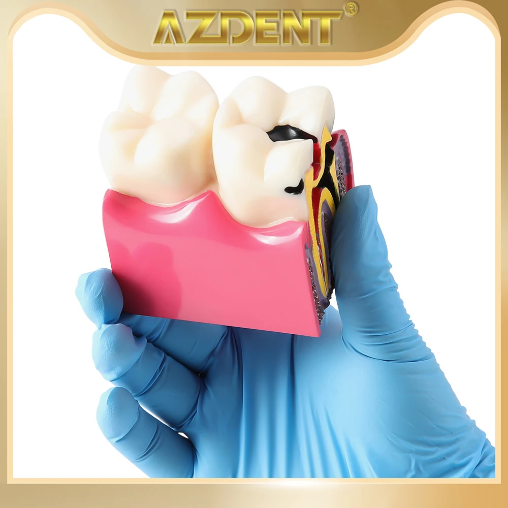 AZDENT Dental Caries Tooth Model 6 Times Decay Teeth Comparative Study Model Bilateral Comparison Pathology Teach Learning Tools
AZDENT Dental Caries Tooth Model 6 Times Decay Teeth Comparative Study Model Bilateral Comparison Pathology Teach Learning Tools