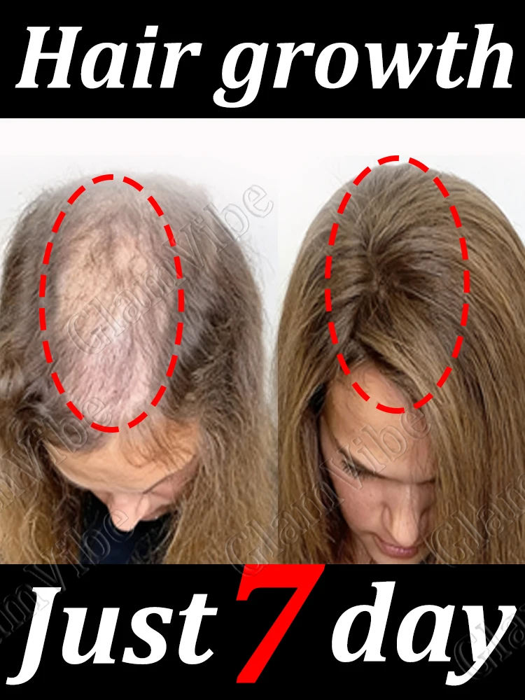 Hᴀɪʀ sᴘʀᴀʏ, like a plant, keeps ɢʀᴏᴡɪɴɢ.
Hᴀɪʀ sᴘʀᴀʏ, like a plant, keeps ɢʀᴏᴡɪɴɢ.