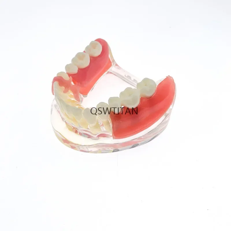 Teeth Model Dental Mandible Implant Overdenture Teeth Model with vessels Demo 6006
Teeth Model Dental Mandible Implant Overdenture Teeth Model with vessels Demo 6006