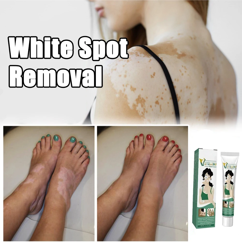 Vitiligo Removal Cream White Spot Care Cream Skincare cream vitiligo skin Sweat spot Reduce white spots Skin care New
Vitiligo Removal Cream White Spot Care Cream Skincare cream vitiligo skin Sweat spot Reduce white spots Skin care New