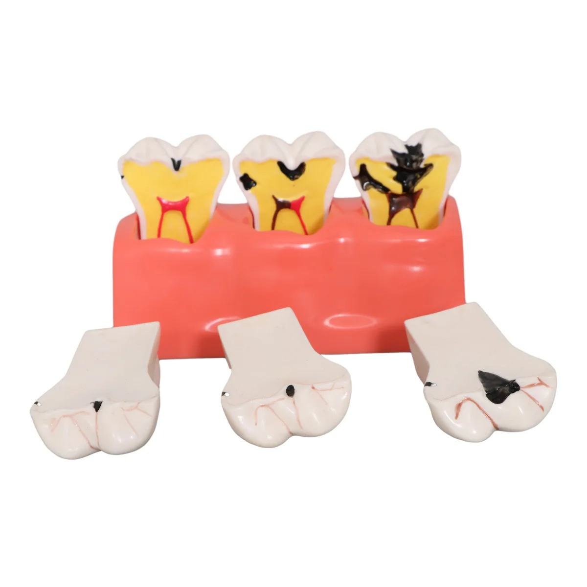 Dental model Dental caries evolution Patient communication model 3-stage four-fold caries decomposition model
Dental model Dental caries evolution Patient communication model 3-stage four-fold caries decomposition model