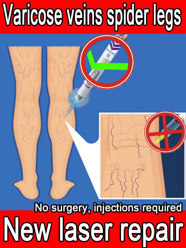 Intravenous laser,Treatment for spider legs, varicose veins, swollen veins, painless removal, varicose veins laser
Intravenous laser,Treatment for spider legs, varicose veins, swollen veins, painless removal, varicose veins laser
