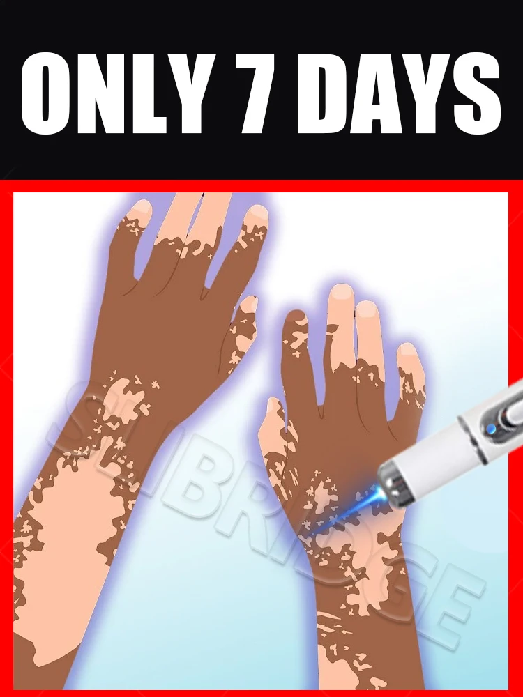 Vitiligo blue light pen,2025 hot sale,Vitiligo care tools,unisex,Generation-2,Combination Set Meals
Vitiligo blue light pen,2025 hot sale,Vitiligo care tools,unisex,Generation-2,Combination Set Meals