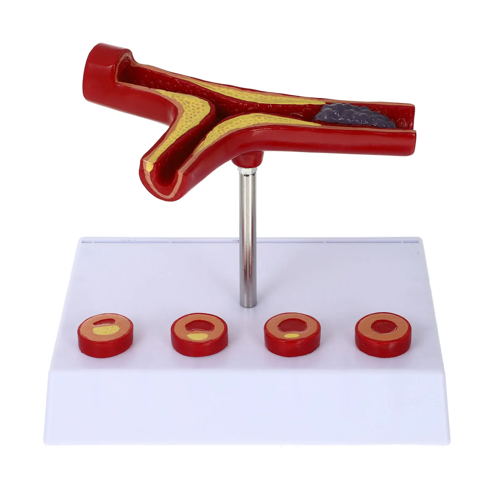 Human Atherosclerosis Cardiovascular Blood Vessel Anatomical Display Teaching Educational Atherosclerosis Show
Human Atherosclerosis Cardiovascular Blood Vessel Anatomical Display Teaching Educational Atherosclerosis Show