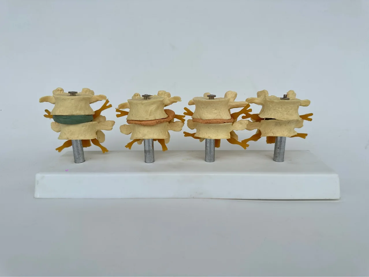 Demonstration model of human lumbar intervertebral disc atrophy with age in osteoporotic stage
Demonstration model of human lumbar intervertebral disc atrophy with age in osteoporotic stage