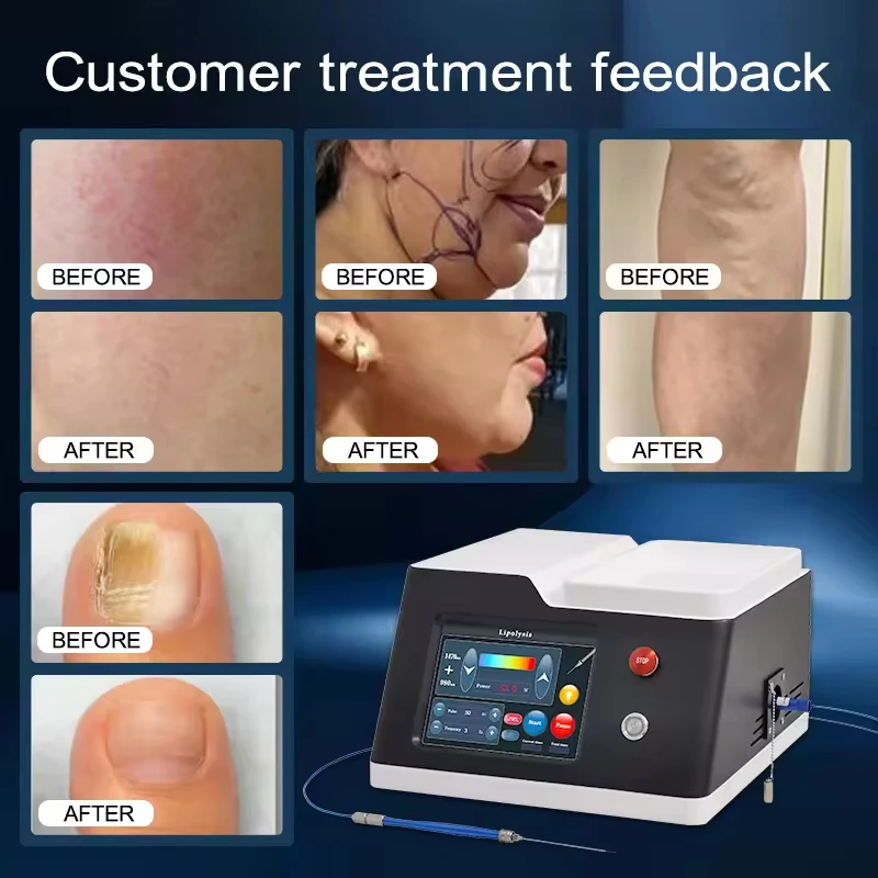 Portable High Power Diode Laser Beauty Equipment with 980nm and 1470nm Waves for Face Lifting and Liposuction
Portable High Power Diode Laser Beauty Equipment with 980nm and 1470nm Waves for Face Lifting and Liposuction