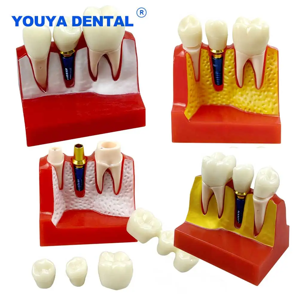 Dental Implant Teeth Model Analysis Crown Bridge 4 Times Demonstration Teeth Model For dental Student Teaching Demo Models
Dental Implant Teeth Model Analysis Crown Bridge 4 Times Demonstration Teeth Model For dental Student Teaching Demo Models