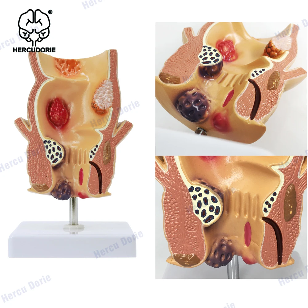 Rectal Hemorrhoid Lesion Model Anatomy Anorectal Department Colorectal Gastroenterology Model
Rectal Hemorrhoid Lesion Model Anatomy Anorectal Department Colorectal Gastroenterology Model