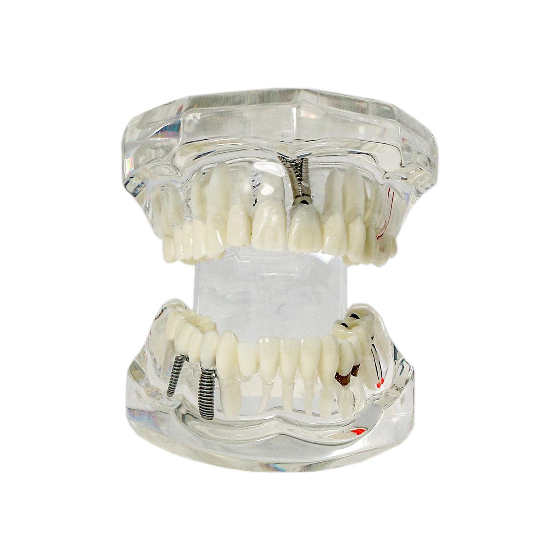 Dental Restoration Pathology Teach Study M2001 Clear Implant Typodonts Teeth Model
Dental Restoration Pathology Teach Study M2001 Clear Implant Typodonts Teeth Model