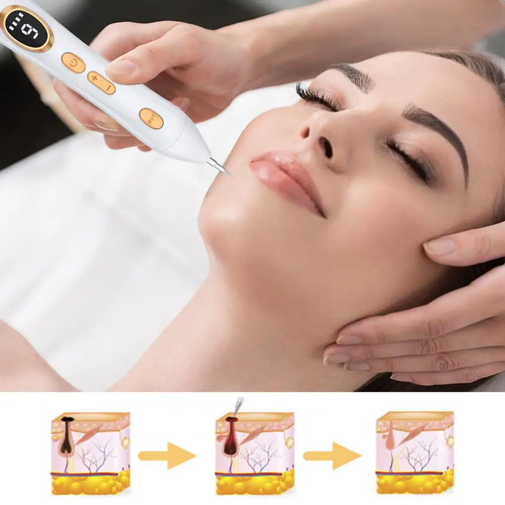 Plasma Technology Skin Tag Remover Portable Skin Tag Removal Kit Painless Mole Wart Skin Tag Remover Pen for Girls Women Home
Plasma Technology Skin Tag Remover Portable Skin Tag Removal Kit Painless Mole Wart Skin Tag Remover Pen for Girls Women Home