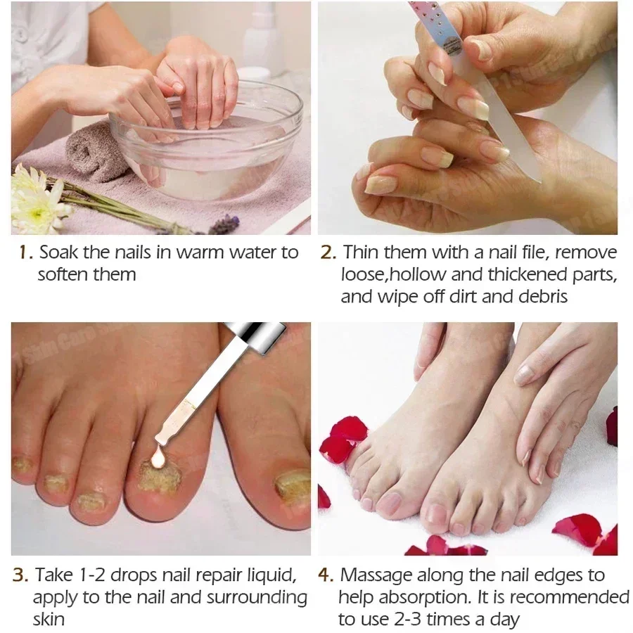 Nail Fungus Treatment Liquid Feet Care Essence Nail Foot Repair Toe Nail Fungal Removal Gel Anti Infection Paronychia Onychomyco
Nail Fungus Treatment Liquid Feet Care Essence Nail Foot Repair Toe Nail Fungal Removal Gel Anti Infection Paronychia Onychomyco