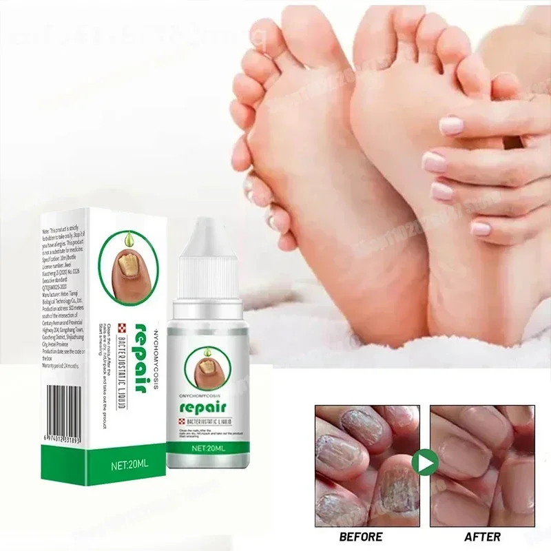 Fungal Nail Treatment Oil Foot Repair Essence Toe Nail Fungus Removal Gel Anti Infection Cream Fungal Nail Removal
Fungal Nail Treatment Oil Foot Repair Essence Toe Nail Fungus Removal Gel Anti Infection Cream Fungal Nail Removal