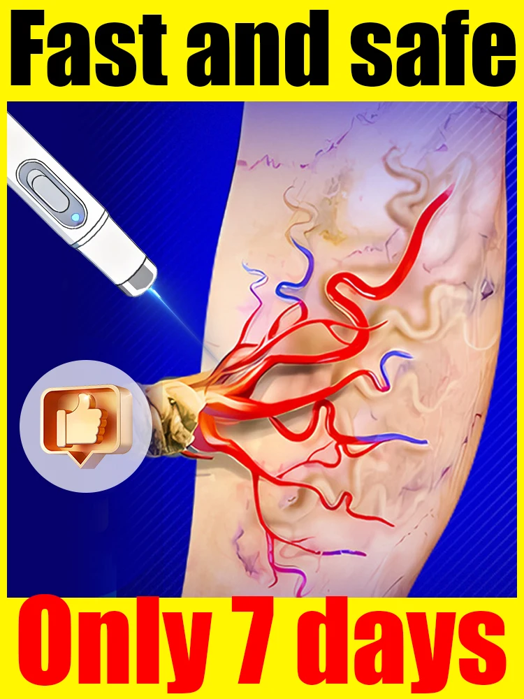 Varicose Veins Blue Light Tool, Easy To Use Skin Care Tool
Varicose Veins Blue Light Tool, Easy To Use Skin Care Tool