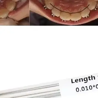 10Pcs Dental Orthodontic Stainless Steel Lingual Retainer Wire Flat Plate Twist Wires Straight Dentistry Materials
10Pcs Dental Orthodontic Stainless Steel Lingual Retainer Wire Flat Plate Twist Wires Straight Dentistry Materials