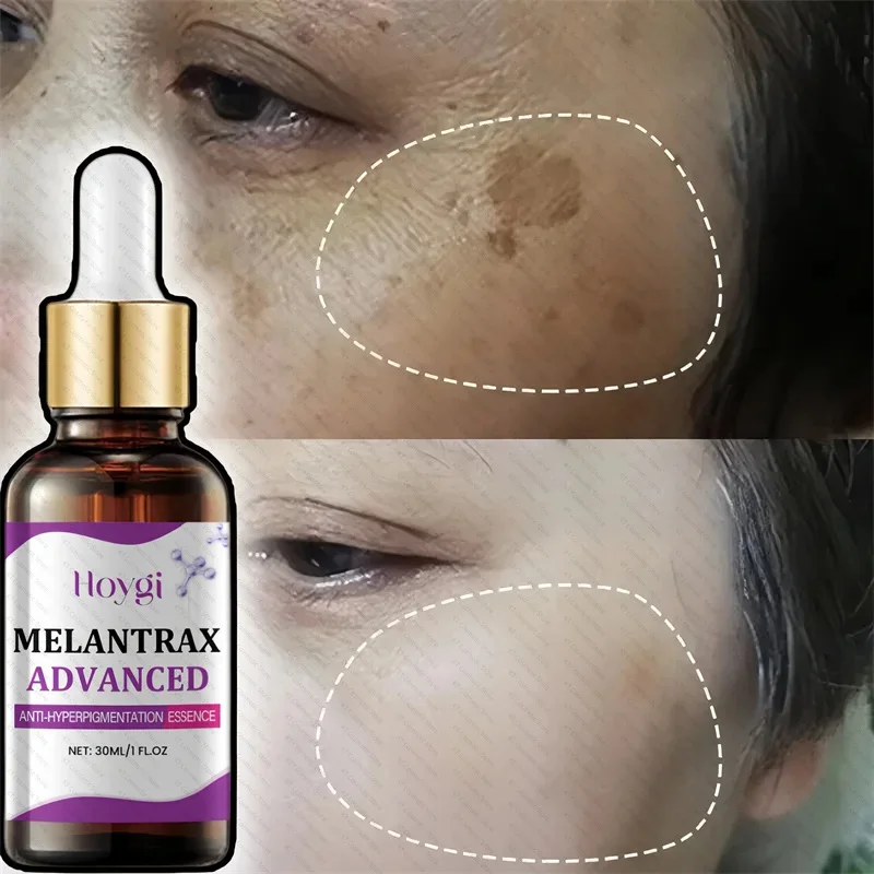 Dark Spots Remover Whitening Serum Face Freckle Melanin Correcting Anti Pigmentation Brighten Beauty Korean Day Night Skin Care
Dark Spots Remover Whitening Serum Face Freckle Melanin Correcting Anti Pigmentation Brighten Beauty Korean Day Night Skin Care