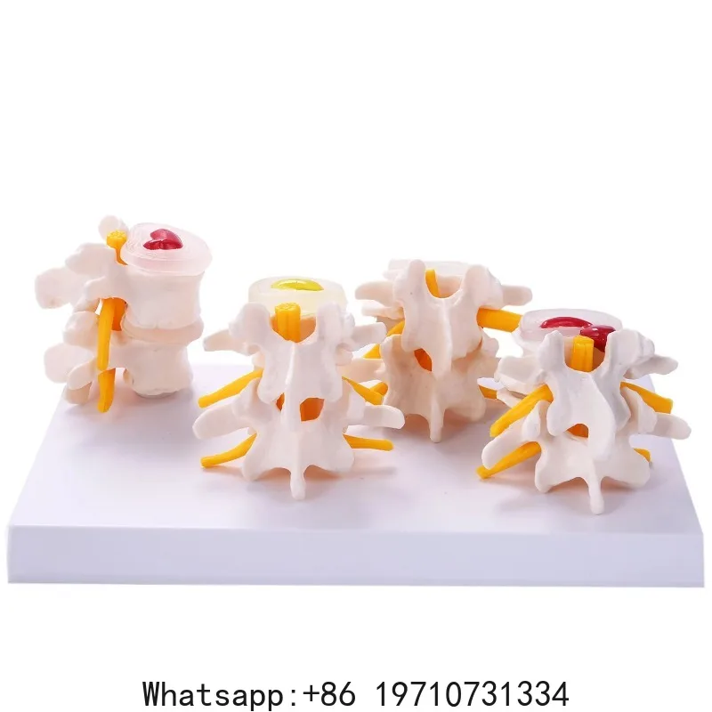 Human Anatomy Skeleton Spine 4-Stages Lumbar Vertebral Model Brain Skull Traumatic Teaching Supplies
Human Anatomy Skeleton Spine 4-Stages Lumbar Vertebral Model Brain Skull Traumatic Teaching Supplies