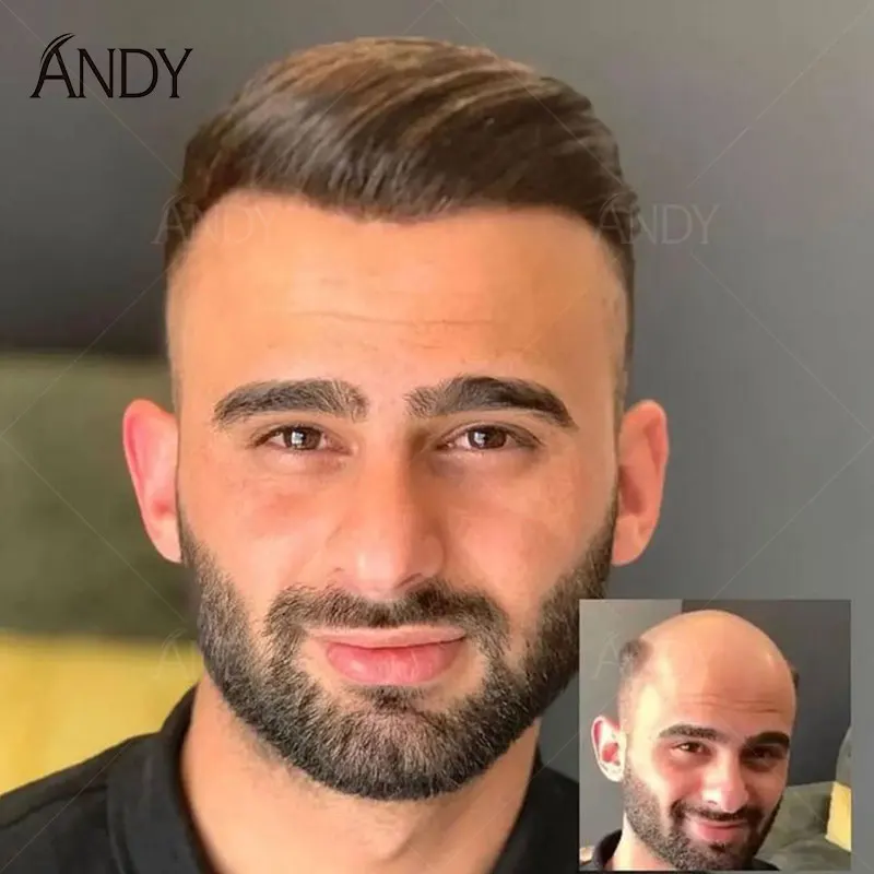 Men Toupee 0.1mm Thin Injection Skin Hair Prosthesis Natural Scalp Effect Breathable Swiss Lace PU Combined Base 100% Human Hair
Men Toupee 0.1mm Thin Injection Skin Hair Prosthesis Natural Scalp Effect Breathable Swiss Lace PU Combined Base 100% Human Hair