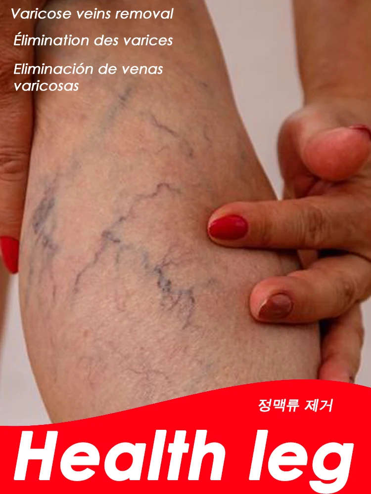 Varicose Leg Cream Spider Veins 30g
Varicose Leg Cream Spider Veins 30g