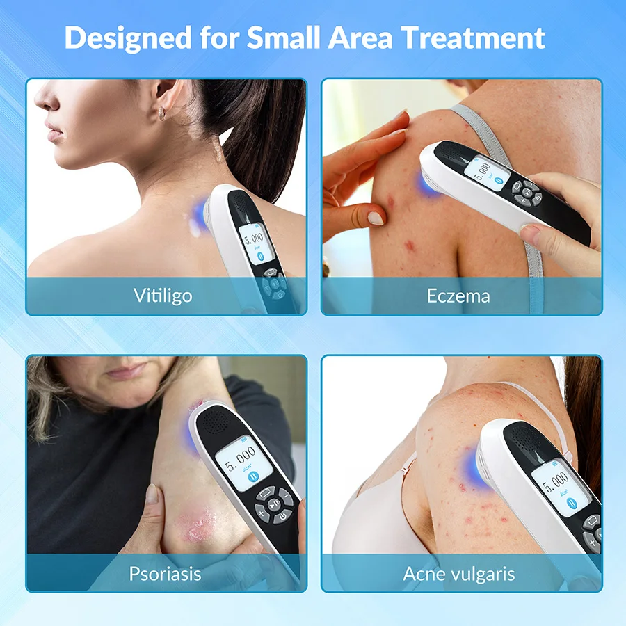 2026 Laser Excimer 308 nm Narrow Band Uvb Phototherapy Excimer Laser Equipment Light Therapy for Vitiligo Treatment with 6 Diode
2026 Laser Excimer 308 nm Narrow Band Uvb Phototherapy Excimer Laser Equipment Light Therapy for Vitiligo Treatment with 6 Diode