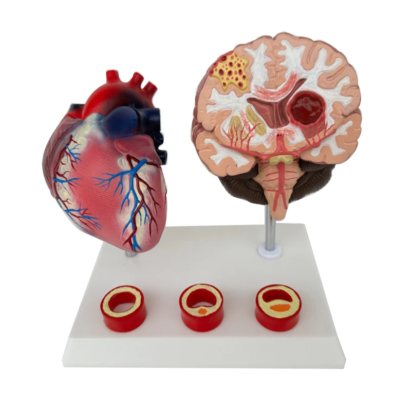 Demonstration model of pathological cerebrovascular disease during blockage of human cardiovascular and cerebrovascular vessels
Demonstration model of pathological cerebrovascular disease during blockage of human cardiovascular and cerebrovascular vessels