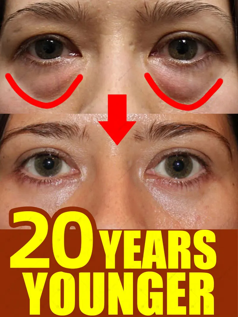 Eye Cream Dark Circles And Bag Removal For Anti Bags In The Eyes Under Contour Area
Eye Cream Dark Circles And Bag Removal For Anti Bags In The Eyes Under Contour Area