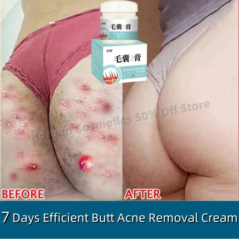 Body Acne Removal Cream Treatment Face Butt Back Acne Marks Bumps Pores Repair Chicken Skin Cream Moisturizing Smooth Skin Care
Body Acne Removal Cream Treatment Face Butt Back Acne Marks Bumps Pores Repair Chicken Skin Cream Moisturizing Smooth Skin Care