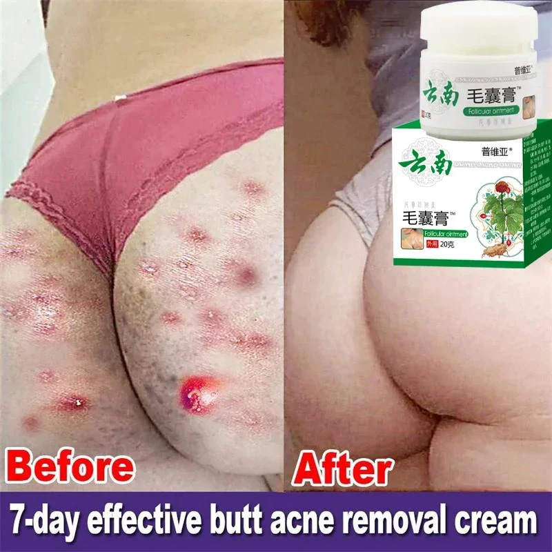 Body Acne Removal Cream Treatment Face Butt Back Acne Marks Smooth Repair Chicken Skin Cream Moisturizing Whitening Skin Care
Body Acne Removal Cream Treatment Face Butt Back Acne Marks Smooth Repair Chicken Skin Cream Moisturizing Whitening Skin Care