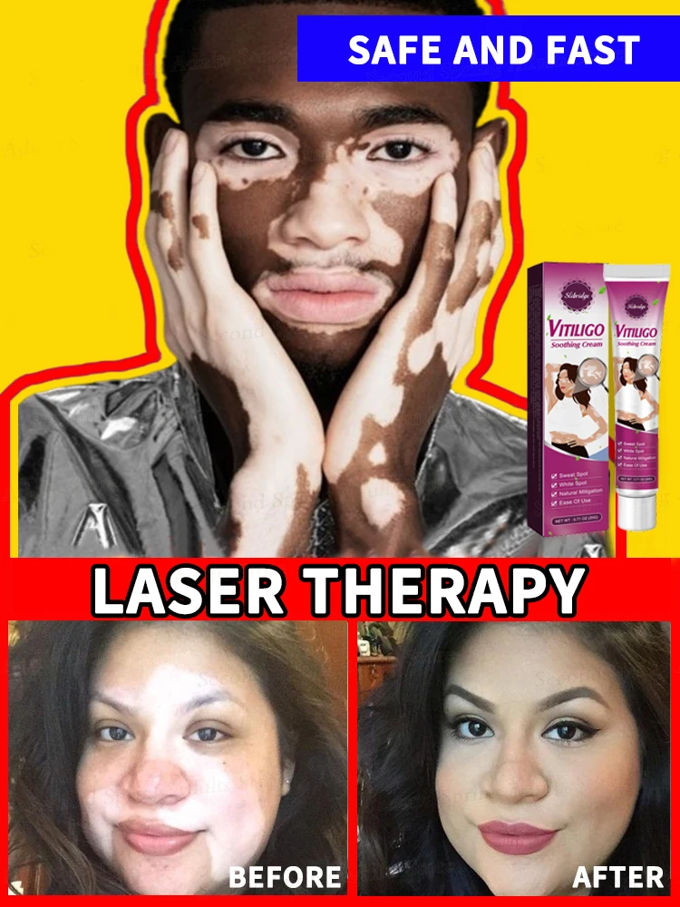 Effective in 7 days, the most popular product in 2025, no longer troubled by white spots, vitiligo patients
Effective in 7 days, the most popular product in 2025, no longer troubled by white spots, vitiligo patients