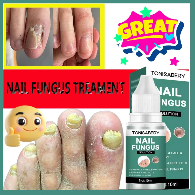 Nail Fungus Treatment Essence Fast Repair Toenail Remove Gray Nail Moisturizing Toenail Care Liquid
Nail Fungus Treatment Essence Fast Repair Toenail Remove Gray Nail Moisturizing Toenail Care Liquid