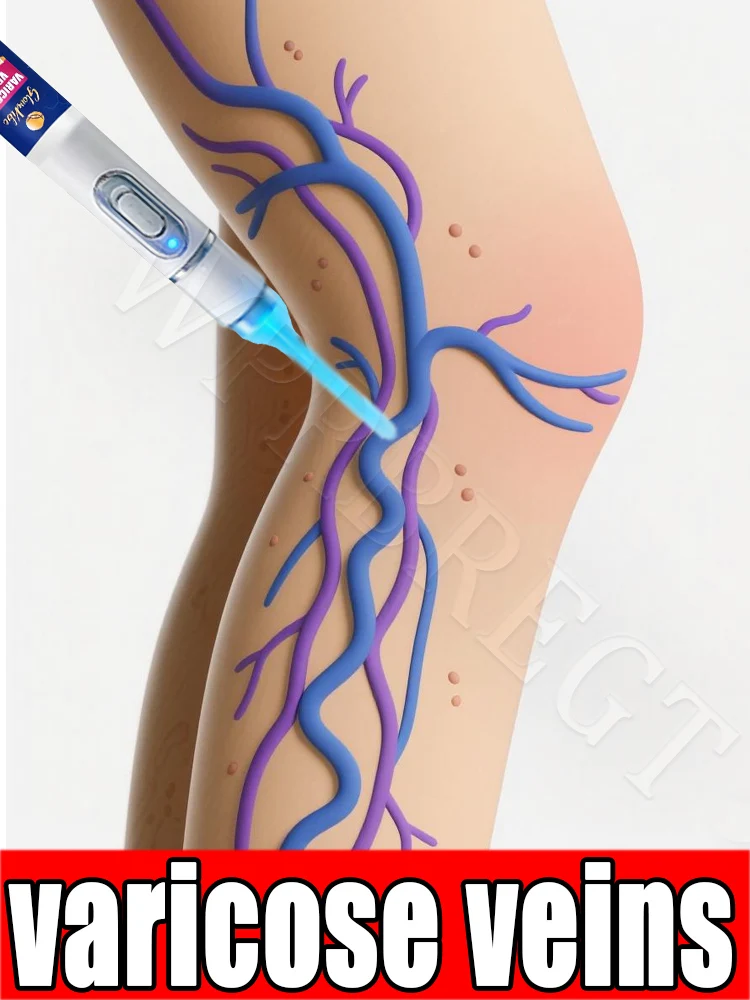 Laser treatment: Easily treat spider leg pain, vasculitis, and phlebitis
Laser treatment: Easily treat spider leg pain, vasculitis, and phlebitis