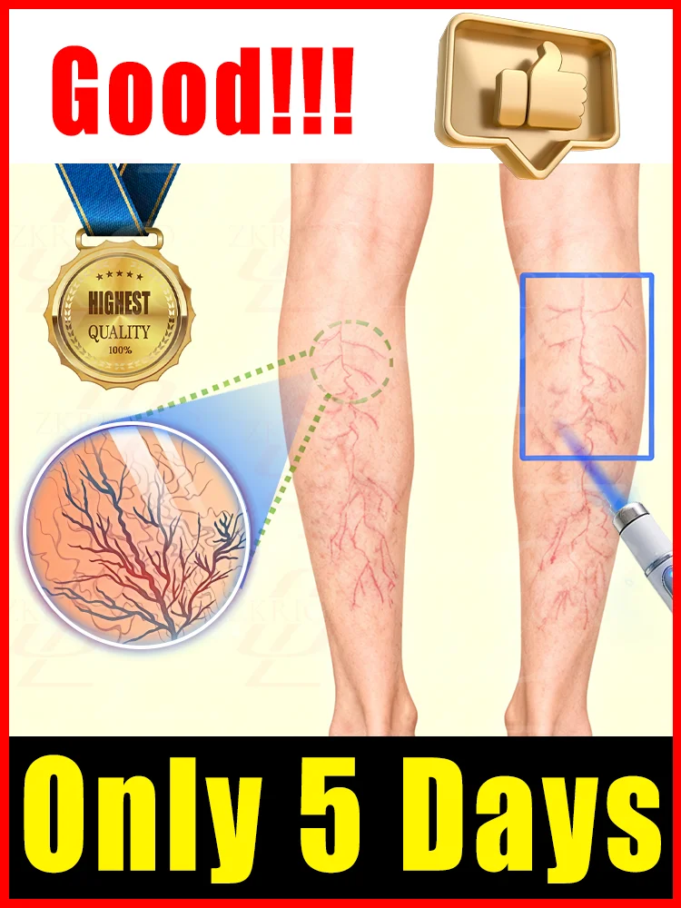 Vᴀʀɪᴄᴏsᴇ ᴠᴇɪɴ ʟᴀsᴇʀ ɪɴsᴛʀᴜᴍᴇɴᴛ
Vᴀʀɪᴄᴏsᴇ ᴠᴇɪɴ ʟᴀsᴇʀ ɪɴsᴛʀᴜᴍᴇɴᴛ