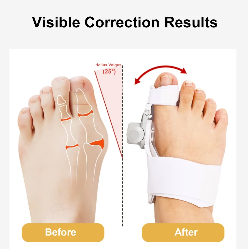 Knob Thumb Valgus Toe Corrector Big Foot Bone Toe Separator Correct Thumb Deformity Adjustable Bunion Corrector Foot Care Tool
Knob Thumb Valgus Toe Corrector Big Foot Bone Toe Separator Correct Thumb Deformity Adjustable Bunion Corrector Foot Care Tool