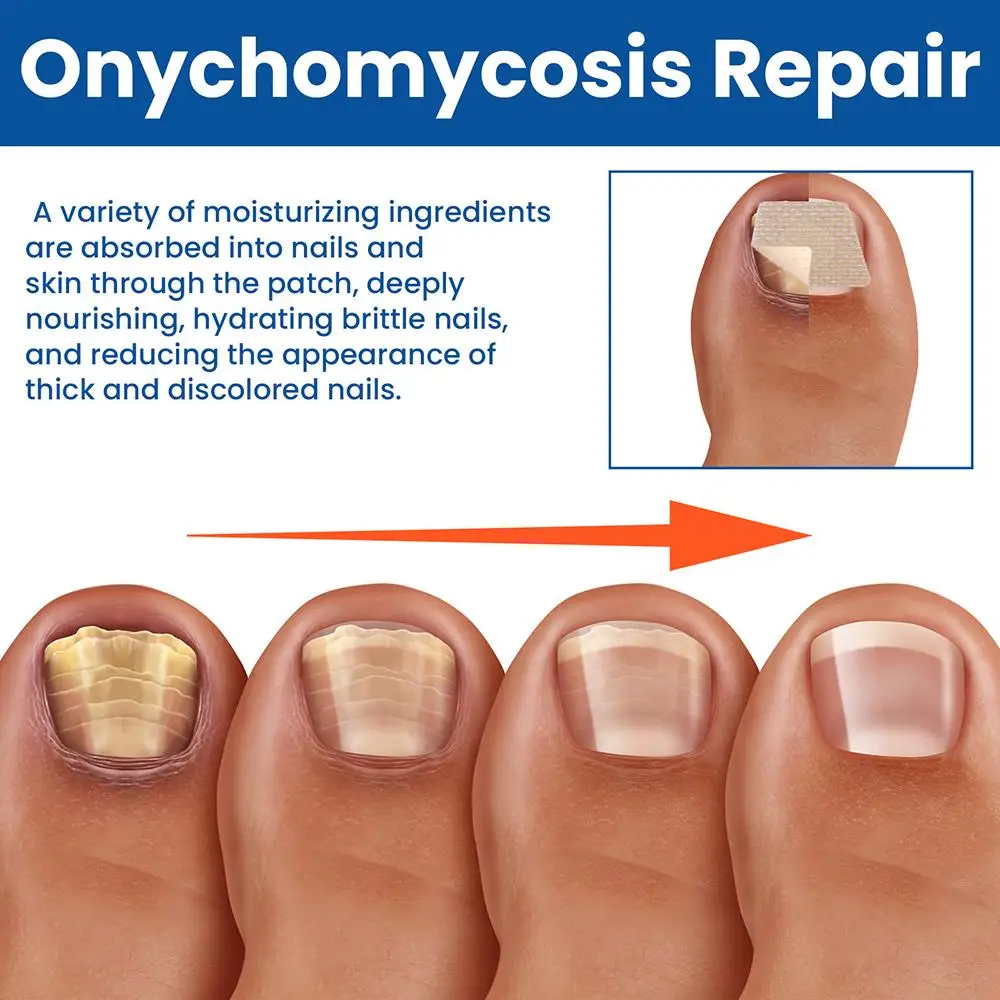 60 шт./компл. патчи для ремонта ногтей, не раздражающие наклейки для коррекции вросших ногтей, помогают треснувшиеся ногти, корректирующая наклейка
60 шт./компл. патчи для ремонта ногтей, не раздражающие наклейки для коррекции вросших ногтей, помогают треснувшиеся ногти, корректирующая наклейка