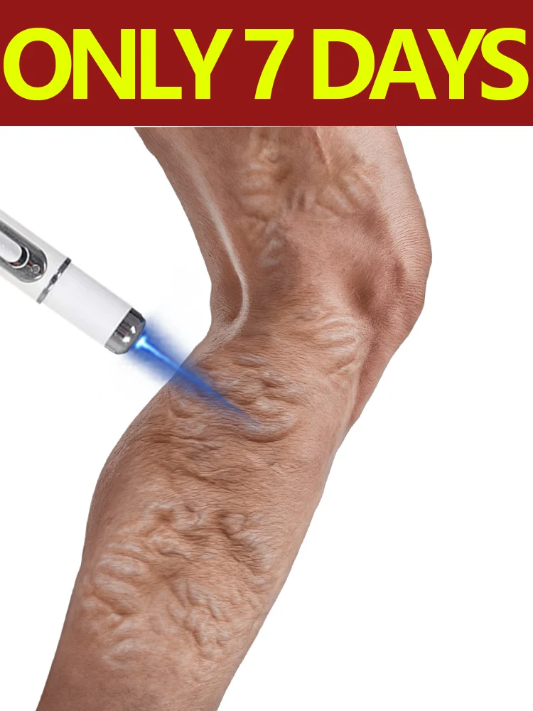 Изменение технологий 2-го поколения, ручка с синим светом VEINS говорят, прощайте проблемы с ногами
Изменение технологий 2-го поколения, ручка с синим светом VEINS говорят, прощайте проблемы с ногами