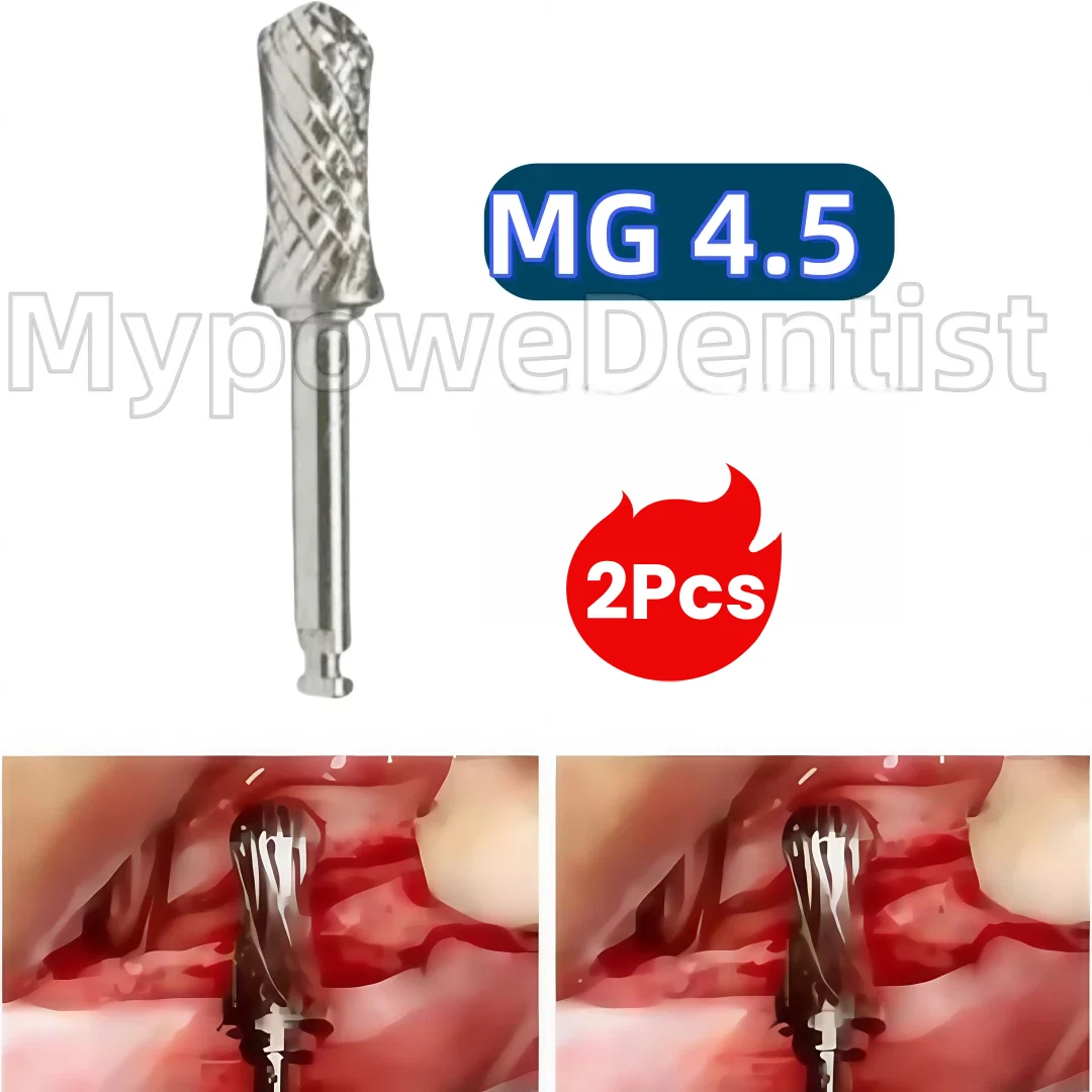 2Pcs Implant Bone Profiler Dental Bone Trimmer Drill Sculpting Shaping Alveolar Ridge
2Pcs Implant Bone Profiler Dental Bone Trimmer Drill Sculpting Shaping Alveolar Ridge