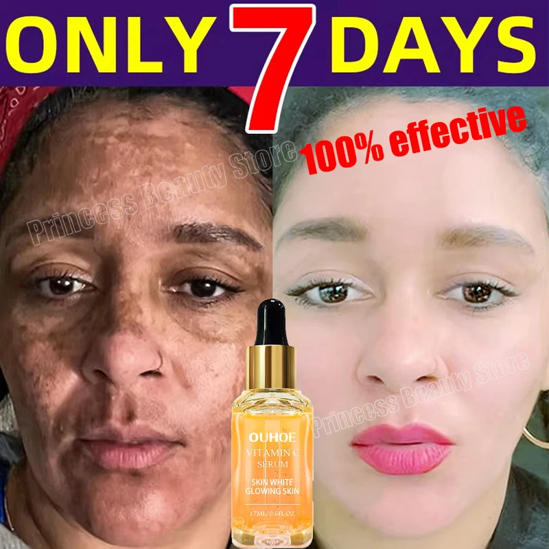 Vitamin C Whitening Serum Face Remove Dark Spots Freckles Fade Melanin Retinol Anti-wrinkle Essence Brightening Korean Skin Care
Vitamin C Whitening Serum Face Remove Dark Spots Freckles Fade Melanin Retinol Anti-wrinkle Essence Brightening Korean Skin Care