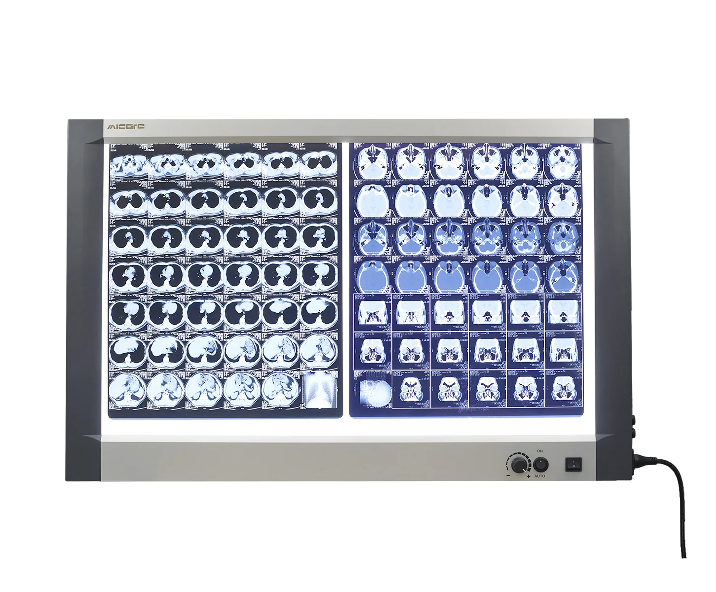 OEM Digital Diagnosis Super Slim Mammography Medical Negatoscope Film Viewer Led X Ray Hospital Blue Film Viewer
OEM Digital Diagnosis Super Slim Mammography Medical Negatoscope Film Viewer Led X Ray Hospital Blue Film Viewer