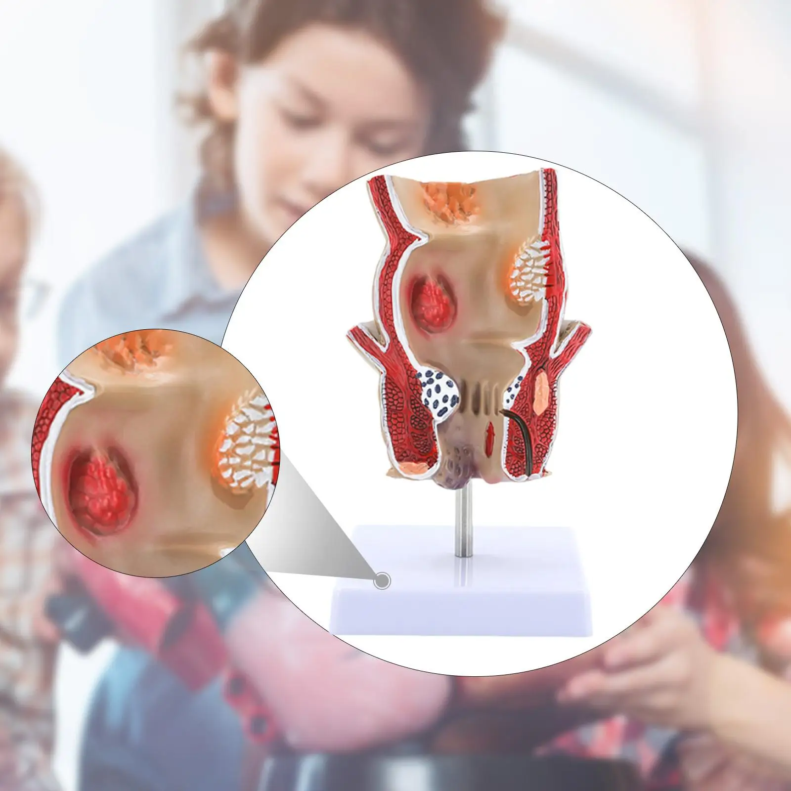 Human Rectum Pathology Model Educational Display Tool for Learning Classroom
Human Rectum Pathology Model Educational Display Tool for Learning Classroom