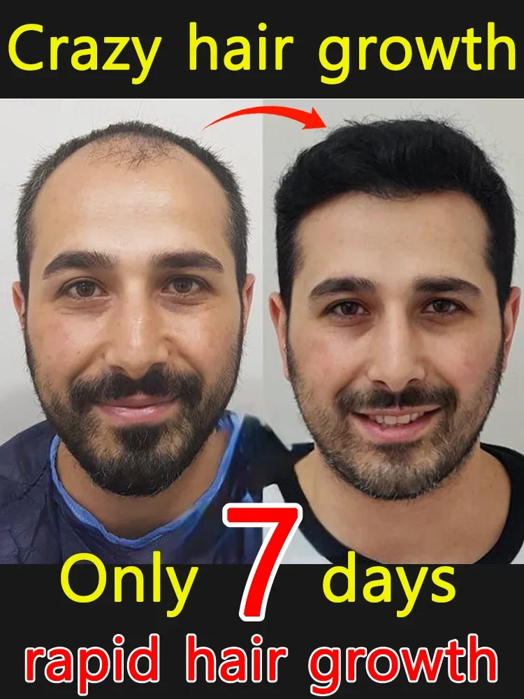 The latest hot-selling product, 98% ofbuyers said goodbye to hair loss, theirhair is getting thicker and thicker
The latest hot-selling product, 98% ofbuyers said goodbye to hair loss, theirhair is getting thicker and thicker
