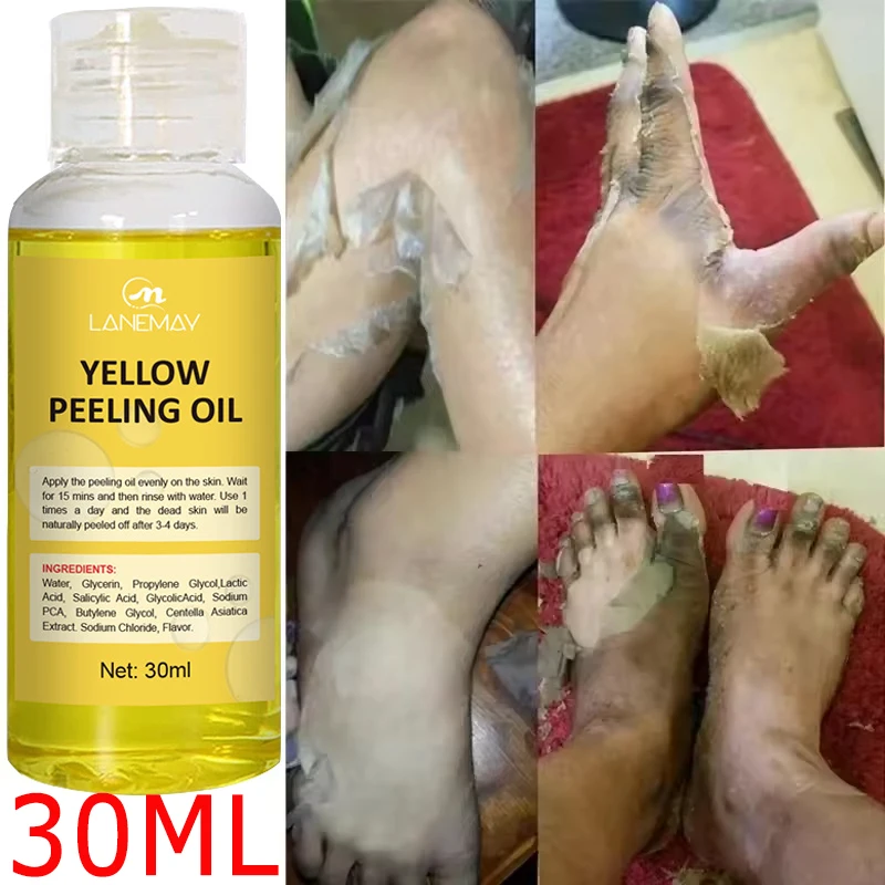 Strong Yellow Peeling Oil Bleach Dark Skin Whiten Lotion Lighten Body Elbow Knee Hand Exfoliate Dead Skin Nourish Even SkinTone
Strong Yellow Peeling Oil Bleach Dark Skin Whiten Lotion Lighten Body Elbow Knee Hand Exfoliate Dead Skin Nourish Even SkinTone