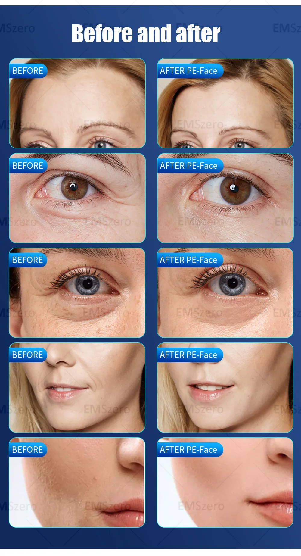 2025 Best Depiladora portable high-power 808nm Diode Laser Hair Removal Machine 3-Wavelength
2025 Best Depiladora portable high-power 808nm Diode Laser Hair Removal Machine 3-Wavelength