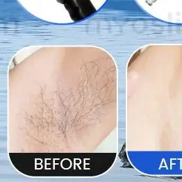 2-in-1 Professional Ice Titanium Diode Laser Hair Removal 808 755 940 1064nm Painless Permanent Epilator for Salon Use
2-in-1 Professional Ice Titanium Diode Laser Hair Removal 808 755 940 1064nm Painless Permanent Epilator for Salon Use