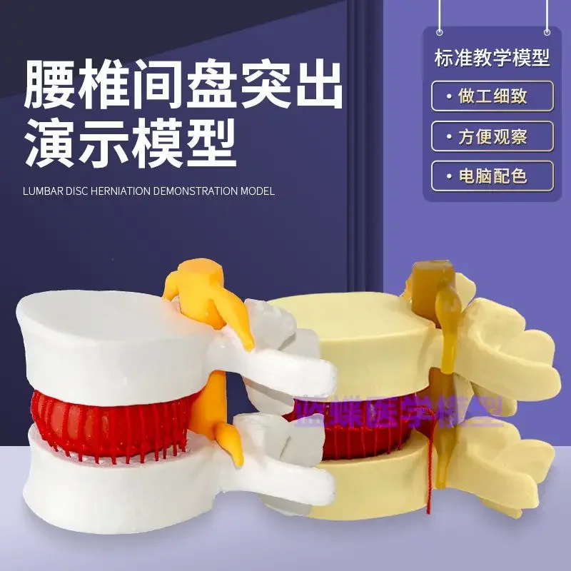 Simulated Lumbar Spine Model Intervertebral Disc 1:1 Human Skeleton Spine Anatomy Medical Teaching Skeleton Specimen
Simulated Lumbar Spine Model Intervertebral Disc 1:1 Human Skeleton Spine Anatomy Medical Teaching Skeleton Specimen