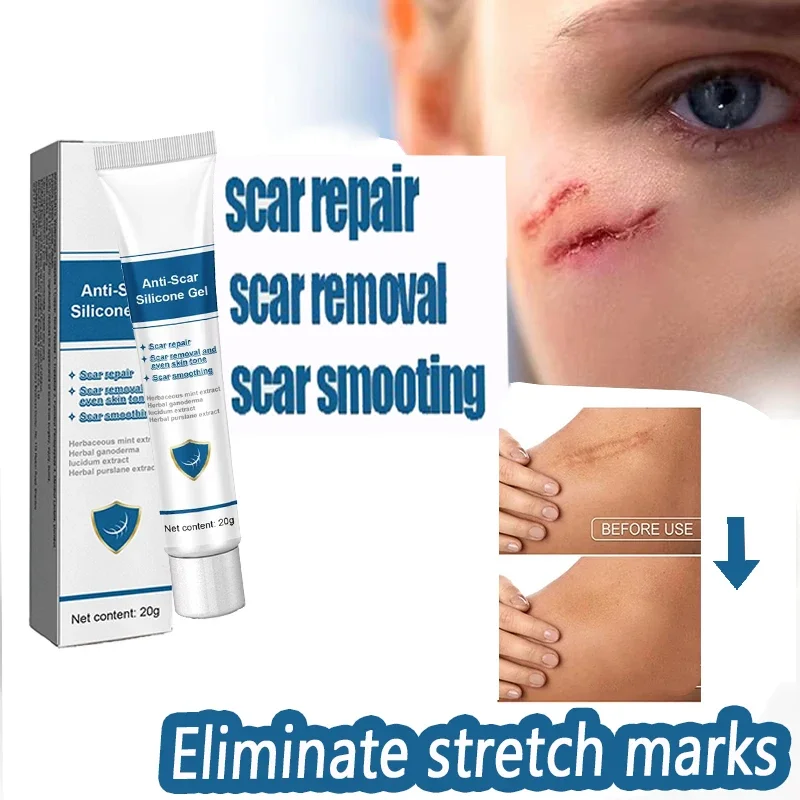 Cream For Pregnancy Stretch Marks Removal Eliminate Red White Old Stretch Marks Oil 2024
Cream For Pregnancy Stretch Marks Removal Eliminate Red White Old Stretch Marks Oil 2024