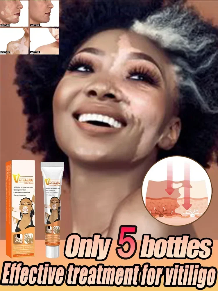 2024 New Natural Vitiligo Ease For Skin Vitiligo Vitiligo Care Cream Reduce White Spots And Improve Skin Pigmentation
2024 New Natural Vitiligo Ease For Skin Vitiligo Vitiligo Care Cream Reduce White Spots And Improve Skin Pigmentation
