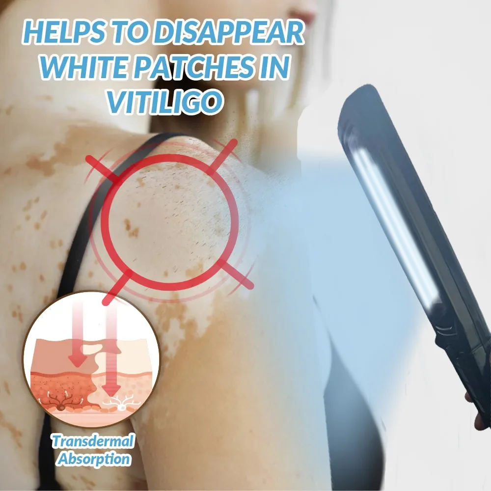 UVB 311nm Ultraviolet Phototherapy Device Uses Lamp UVB To Treat Vitiligo, Psoriasis, White Spots And Skin Diseases
UVB 311nm Ultraviolet Phototherapy Device Uses Lamp UVB To Treat Vitiligo, Psoriasis, White Spots And Skin Diseases