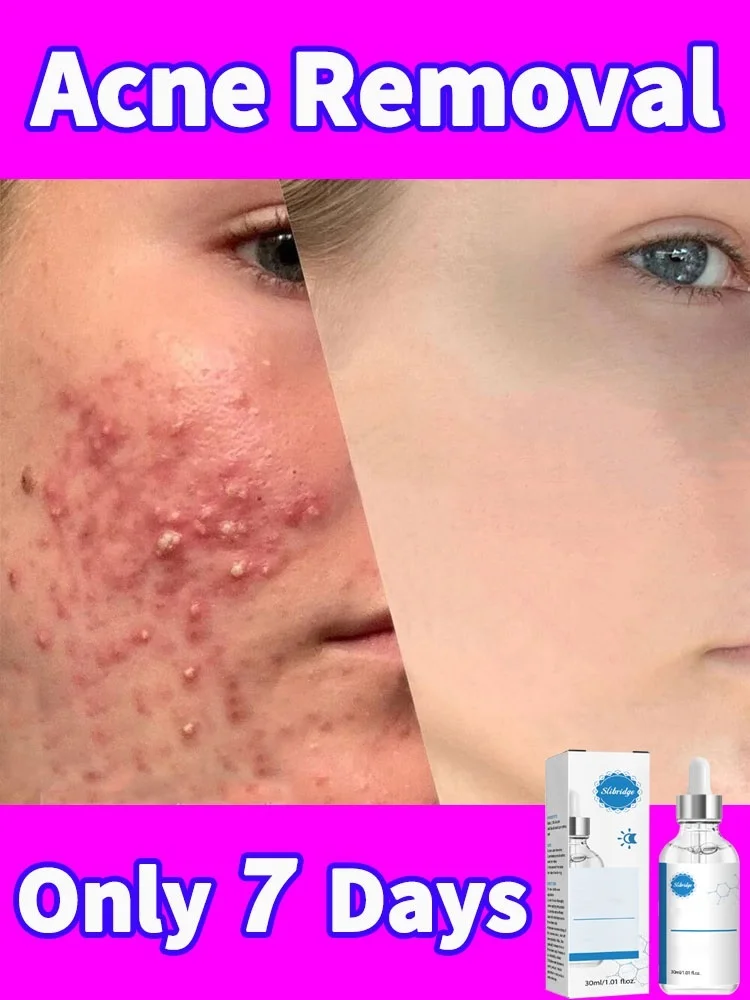 Acne Serum For Face Pimples Remover Shrink Pores Oil Control Lighten Acne Marks Whitening Smoothing Facial Skin Care
Acne Serum For Face Pimples Remover Shrink Pores Oil Control Lighten Acne Marks Whitening Smoothing Facial Skin Care