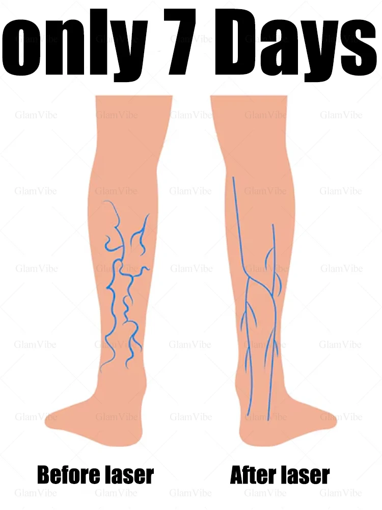 Say goodbye to spider legs varicose veins in 7 days with the second generation laser
Say goodbye to spider legs varicose veins in 7 days with the second generation laser