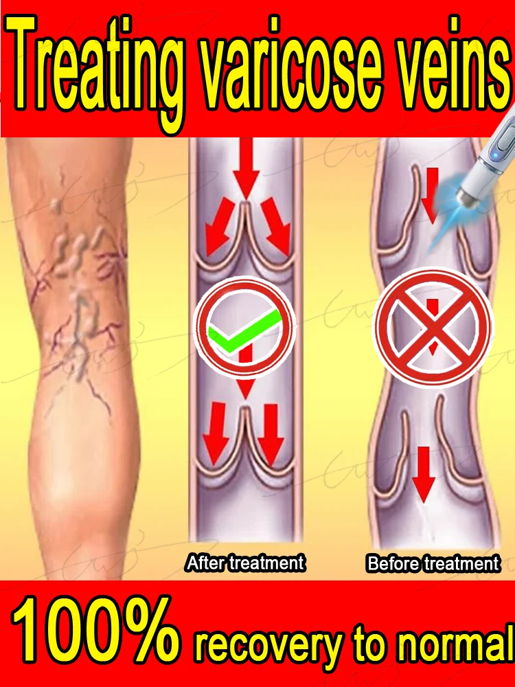 Laser radiofrequency treatment of varicose veins, no surgery required, safe and fast
Laser radiofrequency treatment of varicose veins, no surgery required, safe and fast